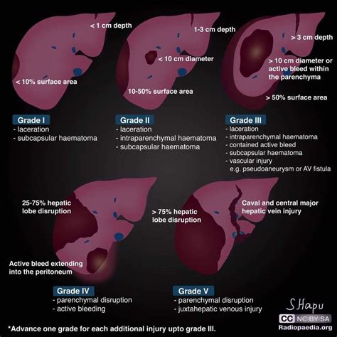 Choosing Liver