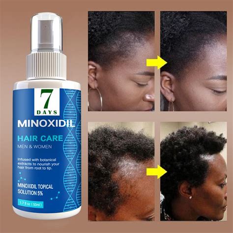 A man using a hair growth product