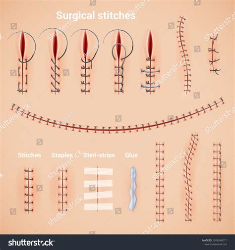 Sutures and Stitches